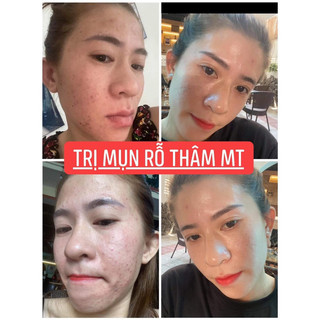 Thảo Dược Sạch Mụn Thâm Rỗ MT