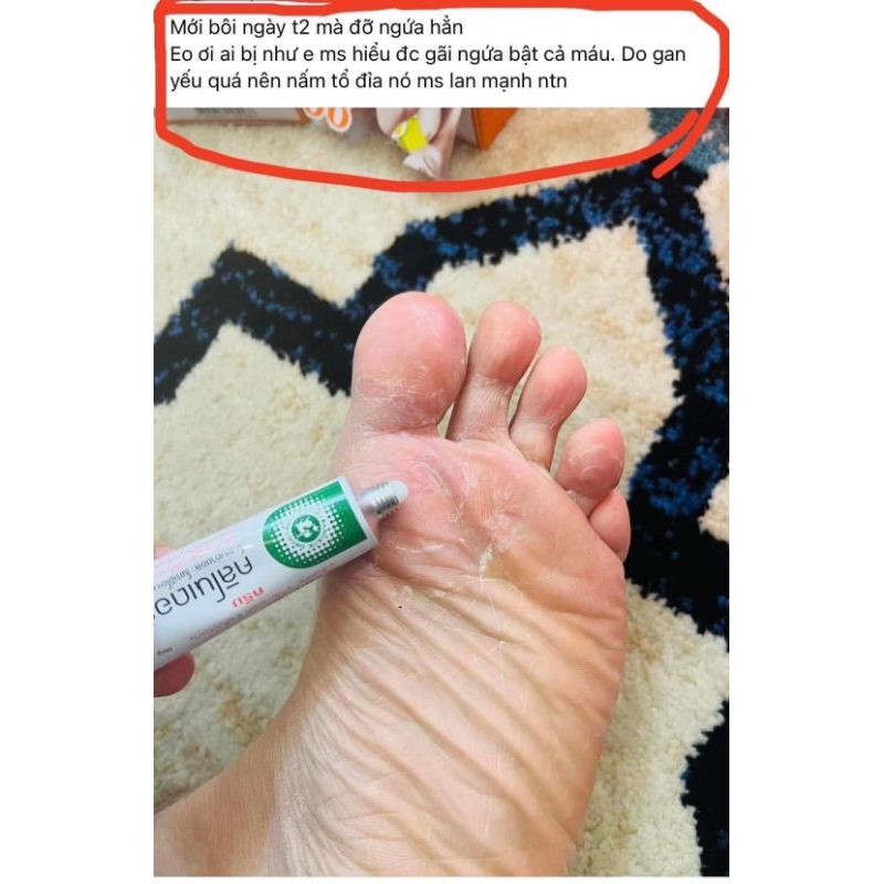 Kem bôi vảy nến, viêm da CLINODERM Thái Lan