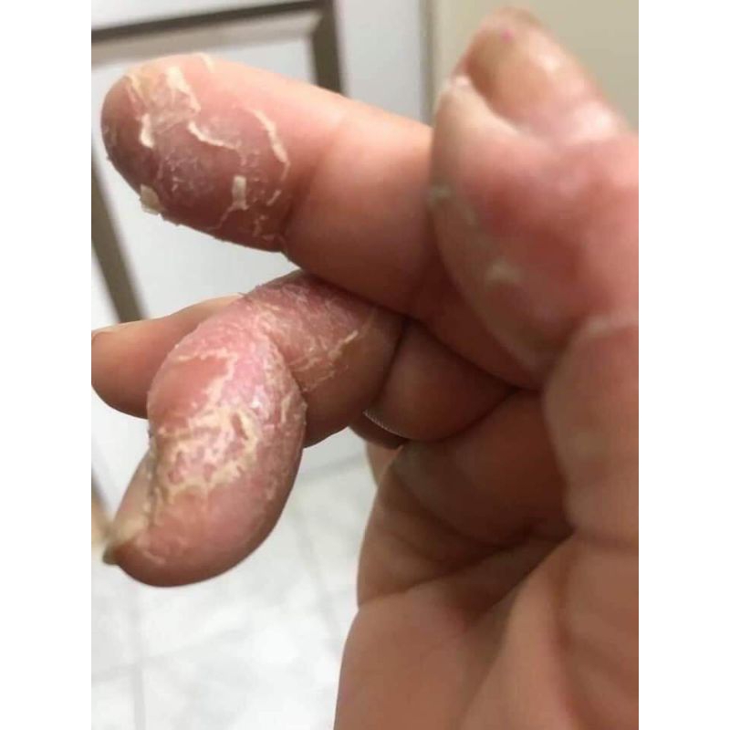 Kem bôi vảy nến, viêm da CLINODERM Thái Lan