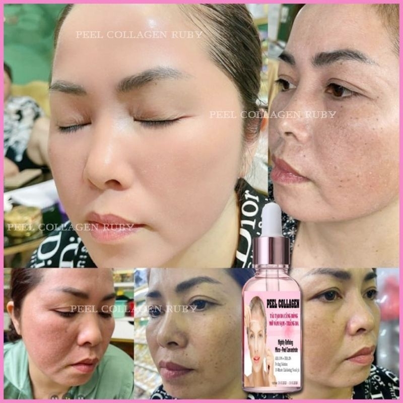 Peel Da Mặt Collagen Cao Cấp Tái Tạo Trắng Da Mờ Thâm Nám Tàn Nhang
