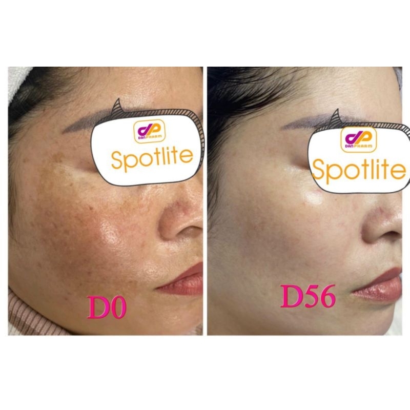 Kem nám Spotlite công nghệ mArn Liposome giảm nám hiệu quả