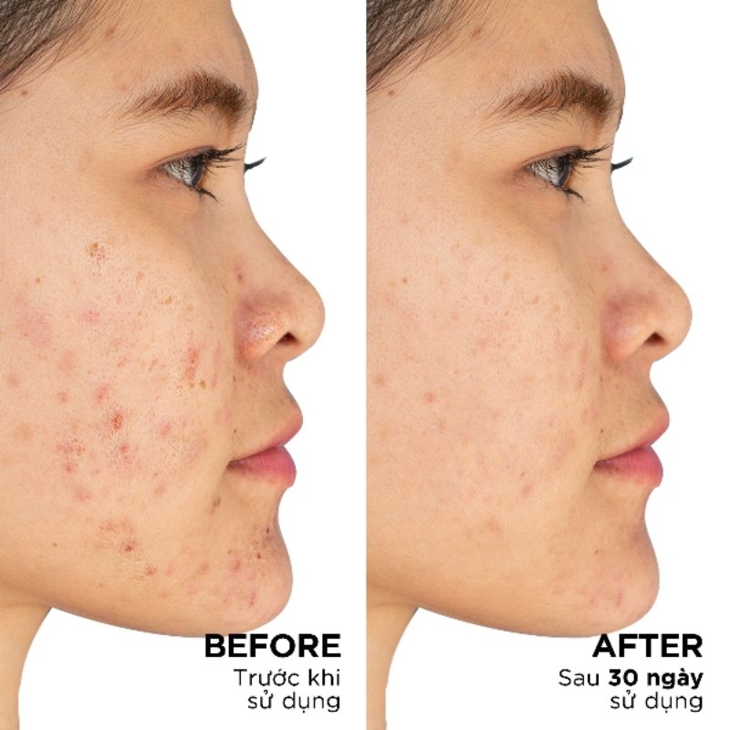 Vitamin tổng hợp giúp giảm mụn, cân bằng nội tiết tố Blissberry Pureskin Acne Support K21 20 viên