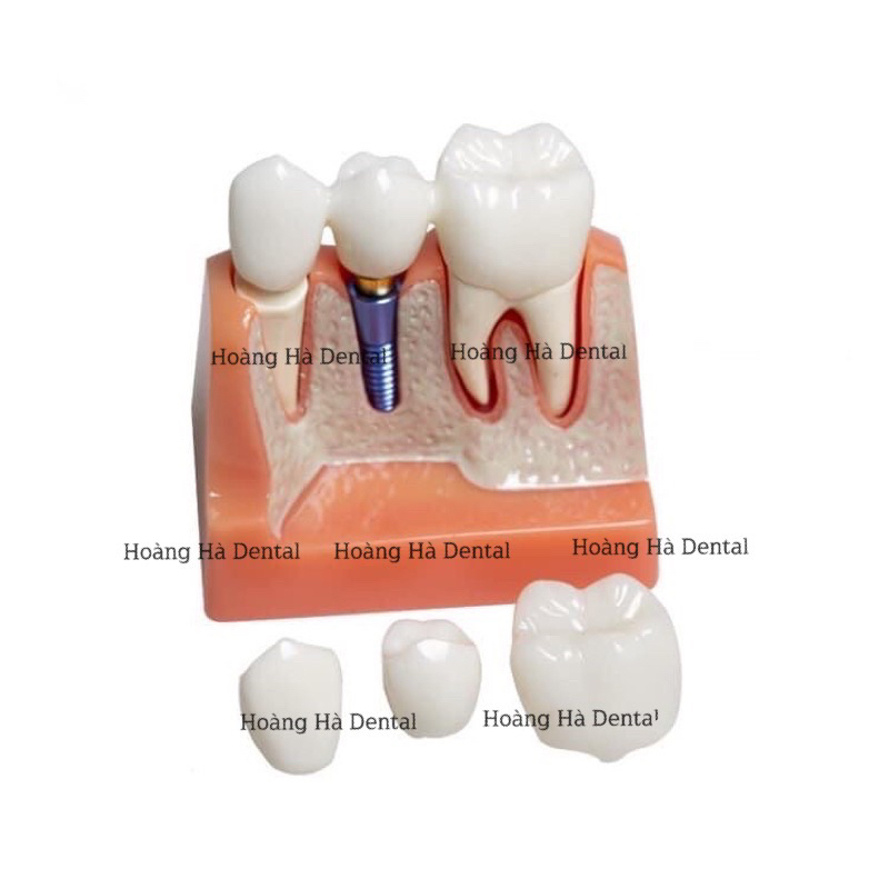 Mẫu hàm tư vấn implant - cầu răng