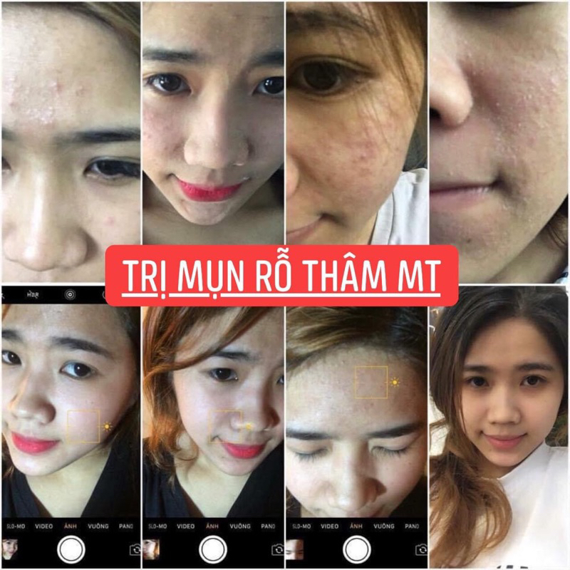 Thảo Dược Sạch Mụn Thâm Rỗ MT