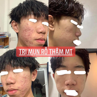 Thảo Dược Sạch Mụn Thâm Rỗ MT