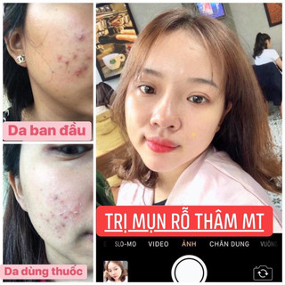 Thảo Dược Sạch Mụn Thâm Rỗ MT