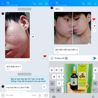 Thảo Dược Sạch Mụn Thâm Rỗ MT