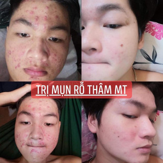 Thảo Dược Sạch Mụn Thâm Rỗ MT