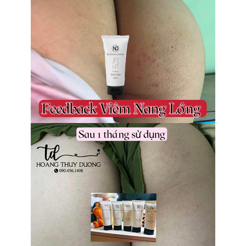 KEM BE CHARM XOÁ THÂM VÒNG 3