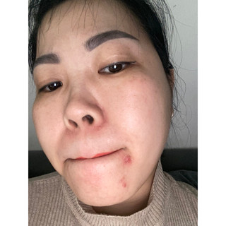 SERUM THÂM MỤN
