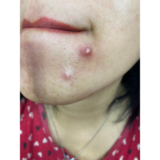 SERUM THÂM MỤN