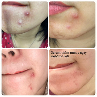 SERUM THÂM MỤN