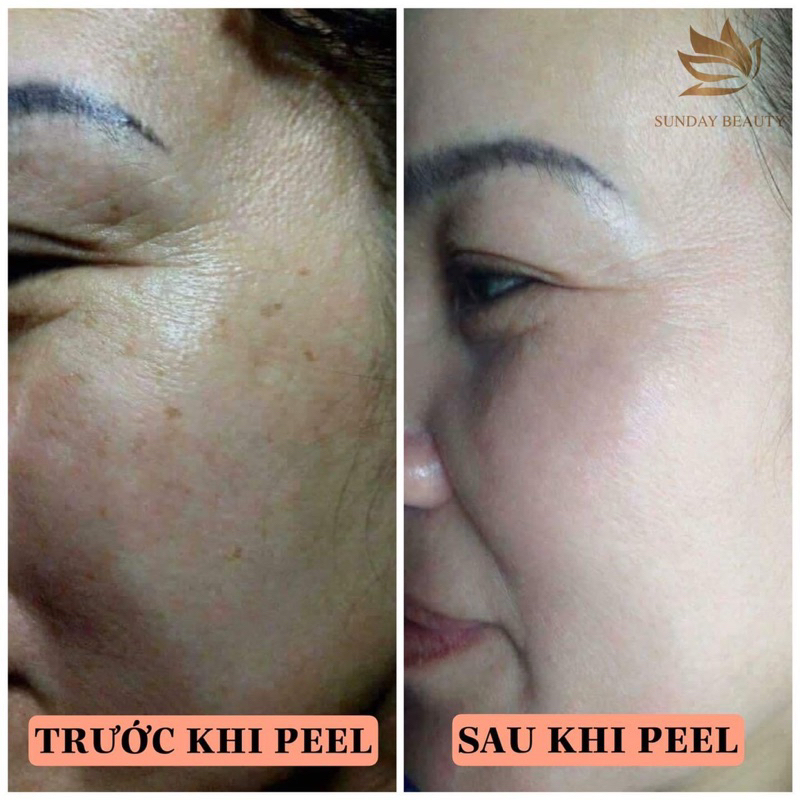 Peel da bong mảng to ROYCE SKIN M+ thay da mụn thâm nám tàn nhang sẹo rỗ lõm