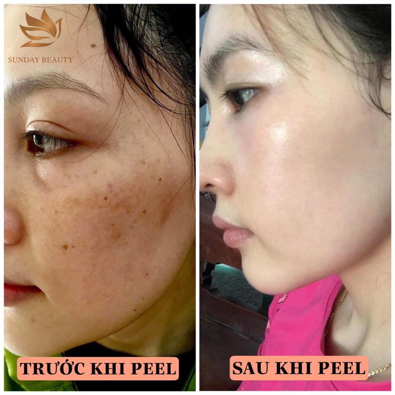 Peel da bong mảng to ROYCE SKIN M+ thay da mụn thâm nám tàn nhang sẹo rỗ lõm