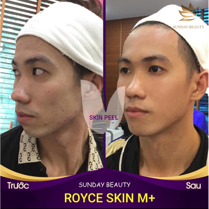 Peel da bong mảng to ROYCE SKIN M+ thay da mụn thâm nám tàn nhang sẹo rỗ lõm