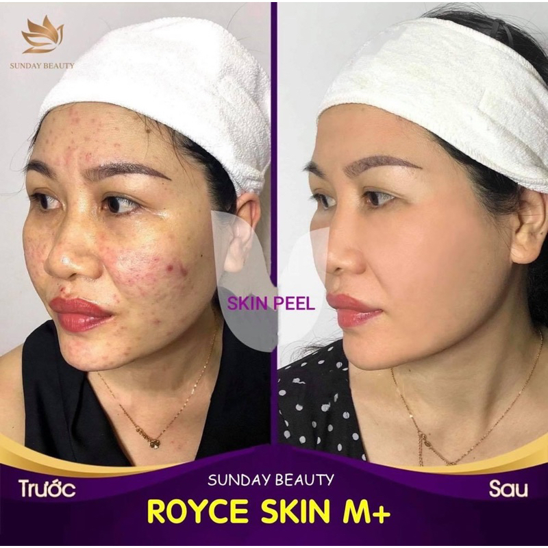 Peel da bong mảng to ROYCE SKIN M+ thay da mụn thâm nám tàn nhang sẹo rỗ lõm