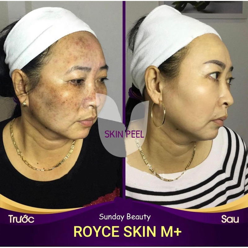 Peel da bong mảng to ROYCE SKIN M+ thay da tách sẹo rỗ lõm nám tàn nhang mụn thâm