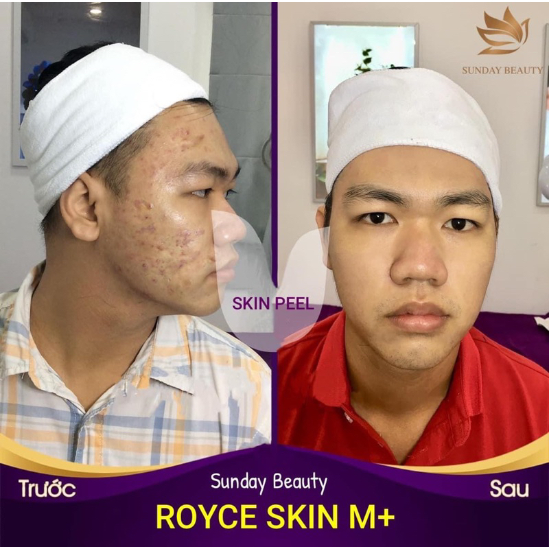 Peel da bong mảng to ROYCE SKIN M+ thay da tách sẹo rỗ lõm nám tàn nhang mụn thâm