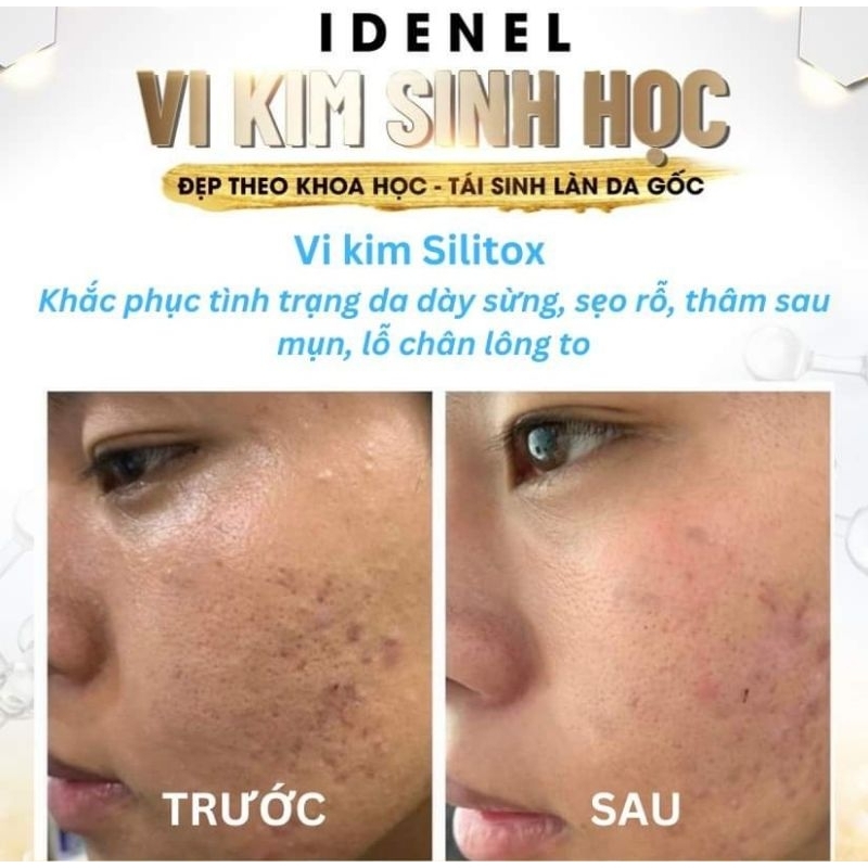 Combo vi kim sinh học Silitox 200% chăm sóc da tại nhà - Da nhăn, trùng nhão, chảy xệ - Da mụn bít tắc - thâm sau mụn