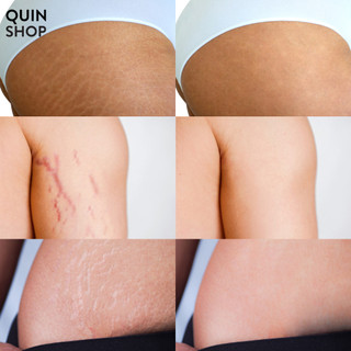 Kem Mờ Rạn StretcHeal Anti Stretch Marks & Scars