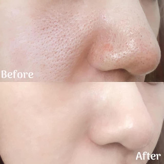 Serum RED PEEL TINGLE - White Serum tinh chất thay da sinh học peel da nhập khẩu chính hãng 35ml