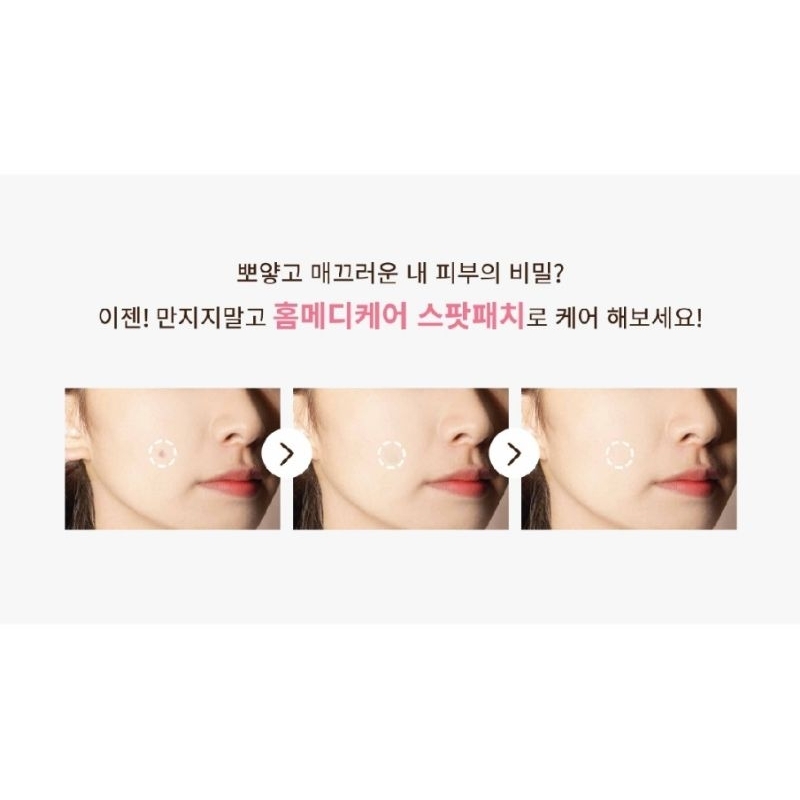 MIẾNG DÁN NGỪA VÀ CHE MỤN MỦ-VẾT THƯƠNG LASER 1 PATCH 48 MIẾNG