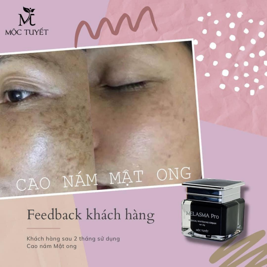 Cao Nám Mật Ong Melasma Pro
