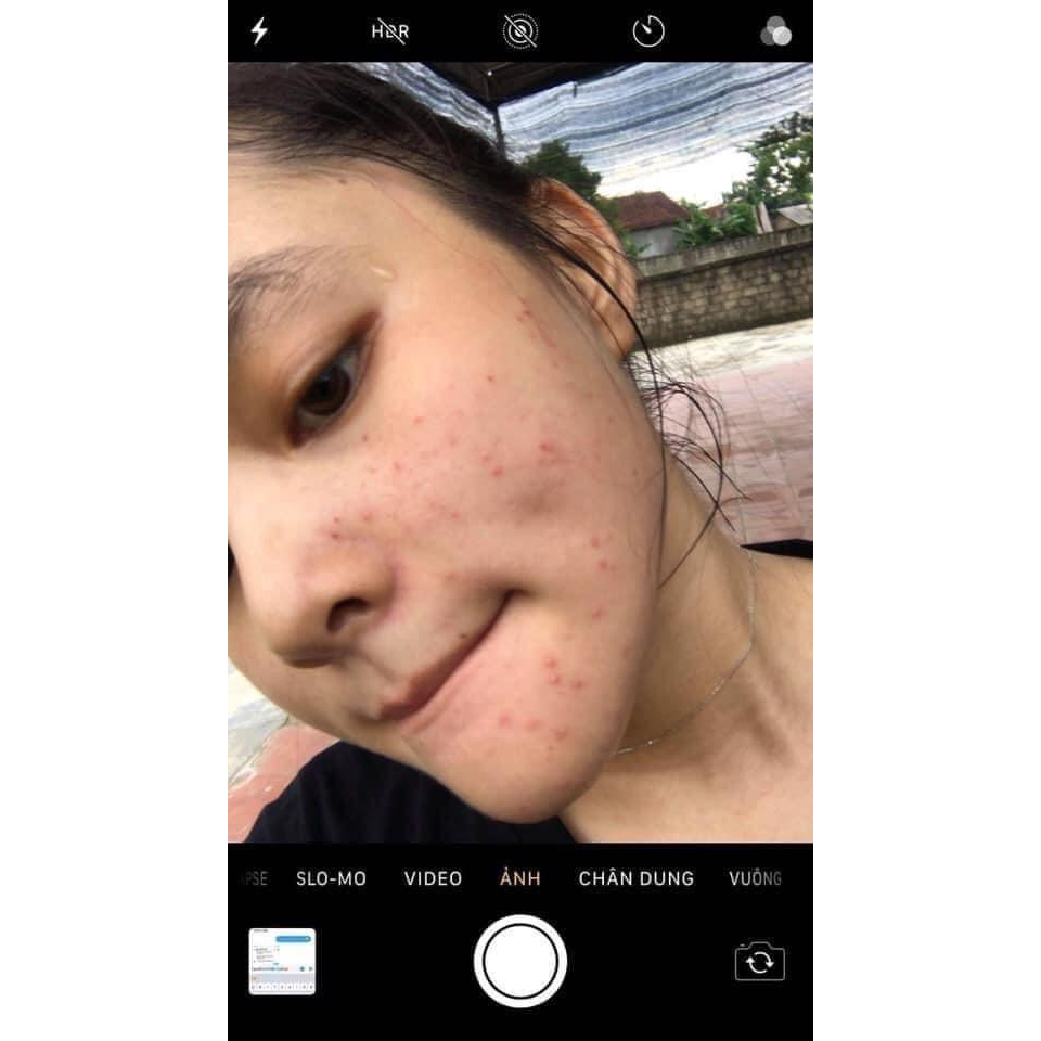 Serum huyet thanh giảm mụn mộc dưỡng da tuyết