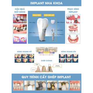 Tranh nha khoa,Tranh phòng răng,Tranh Decan dán bóng:Implant nha khoa