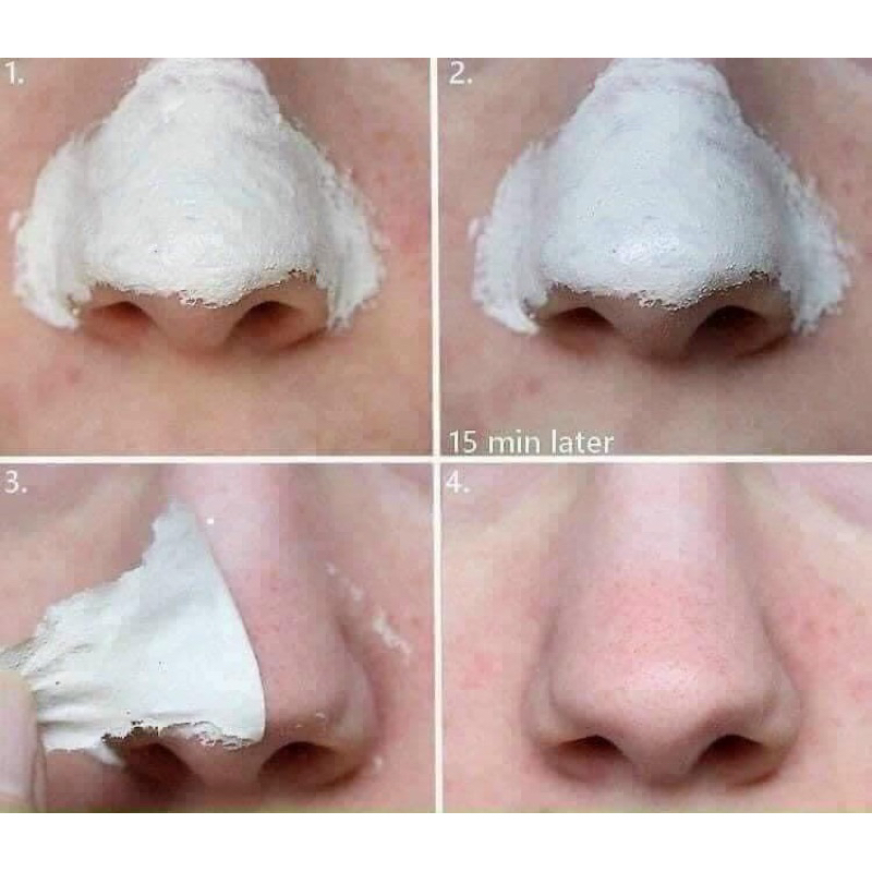 Gel Hút Lột Mụn Đầu Đen Nha Đam White