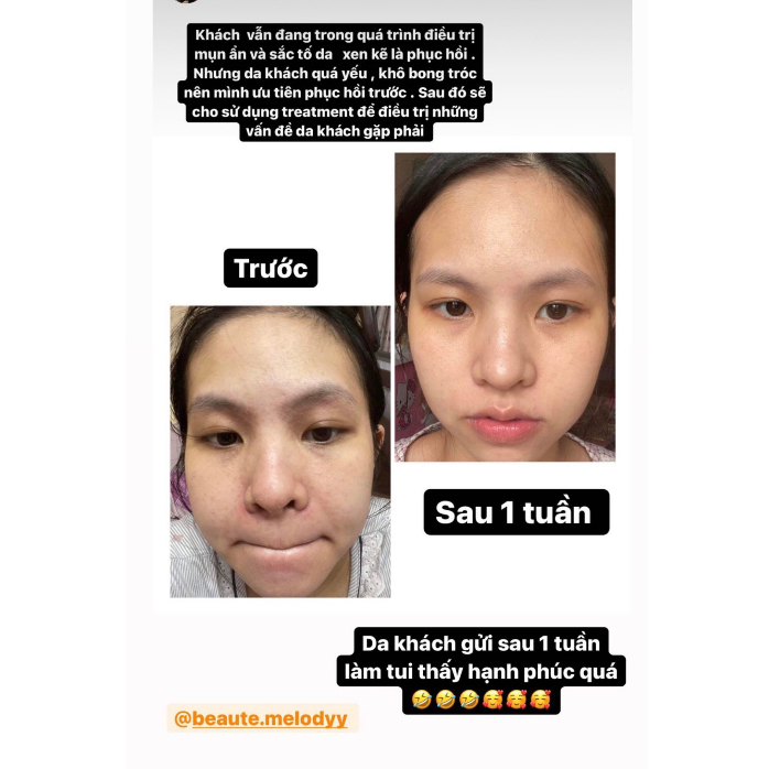 Làm Lành Sẹo Và Cấp Ẩm Cho Da Avene Cicalfate