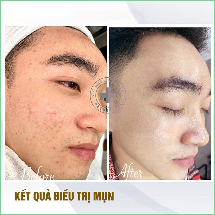 Tế Bào Gốc Mụn IDr Skin Bio Complex Acne Bio Treatment Ampoule