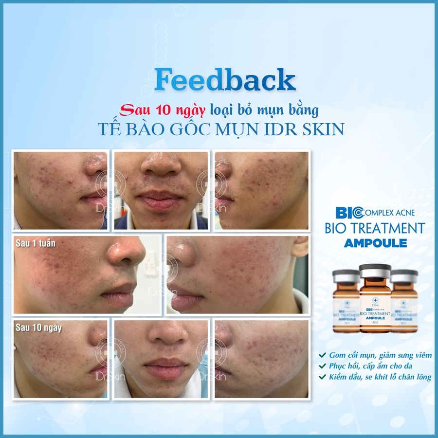 Tế Bào Gốc Mụn IDr Skin Bio Complex Acne Bio Treatment Ampoule
