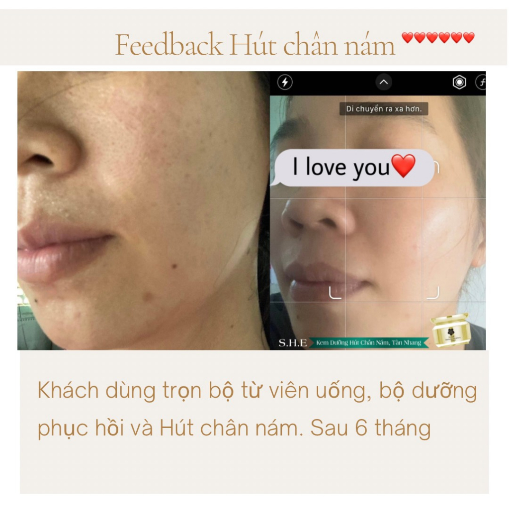 Kem Dưỡng Ức Chế - Hút Chân Nám - Tàn Nhang She Peeling