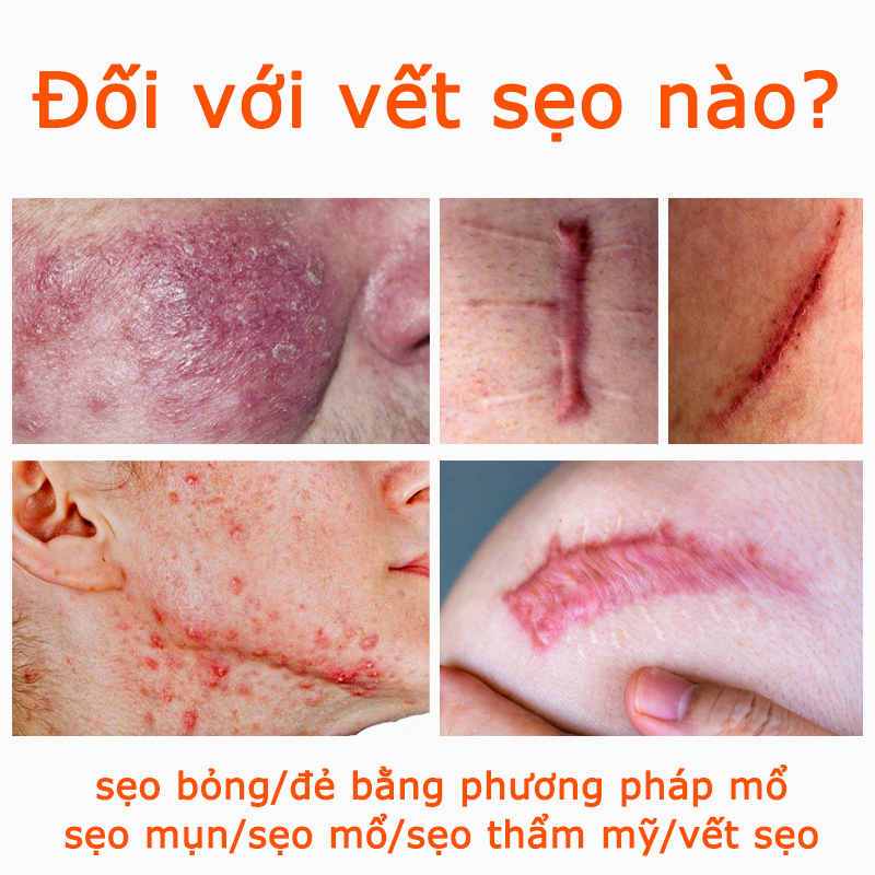 15 ngày xóa sẹo liên tục vết sẹo、Loại bỏ vết rạn da、sẹo lồi