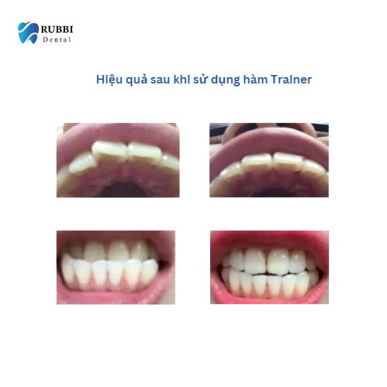 Niềng răng trong suốt niềng răng tại nhà chính hãng TRAINER - Bộ chỉnh nha dành cho người lớn và trẻ em A1 + A2 + A3 | BigBuy360 - bigbuy360.vn