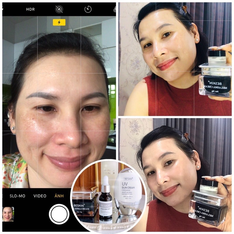 KEM NÁM MELASMA CREAM BESKIN