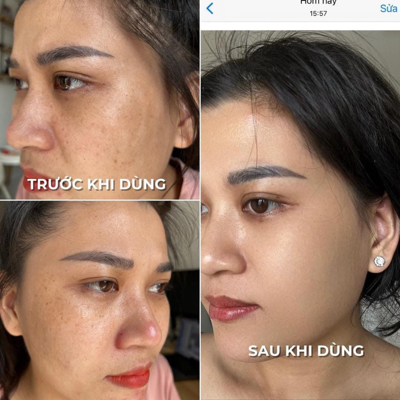 KEM NÁM MELASMA CREAM BESKIN