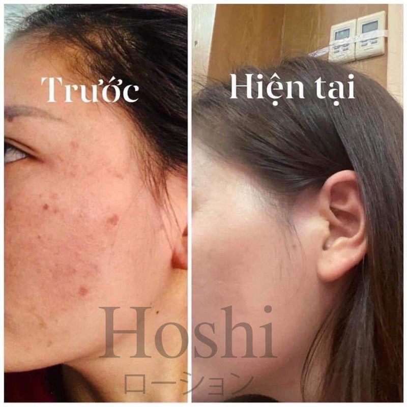 Kem Hoshi Nhật Bản chính hãng giảm thâm nám tàn nhang ngừa lão hoá trắng da 18g - Marisa Beauty