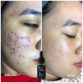 Serum giảm mụn mờ thâm BH 10ml