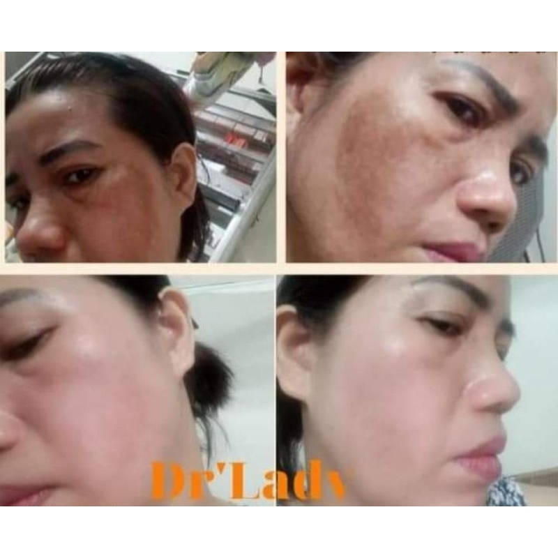 Kem chấm nám mạnh , nám chân sâu Dr LADY Melasma Correcting Cream