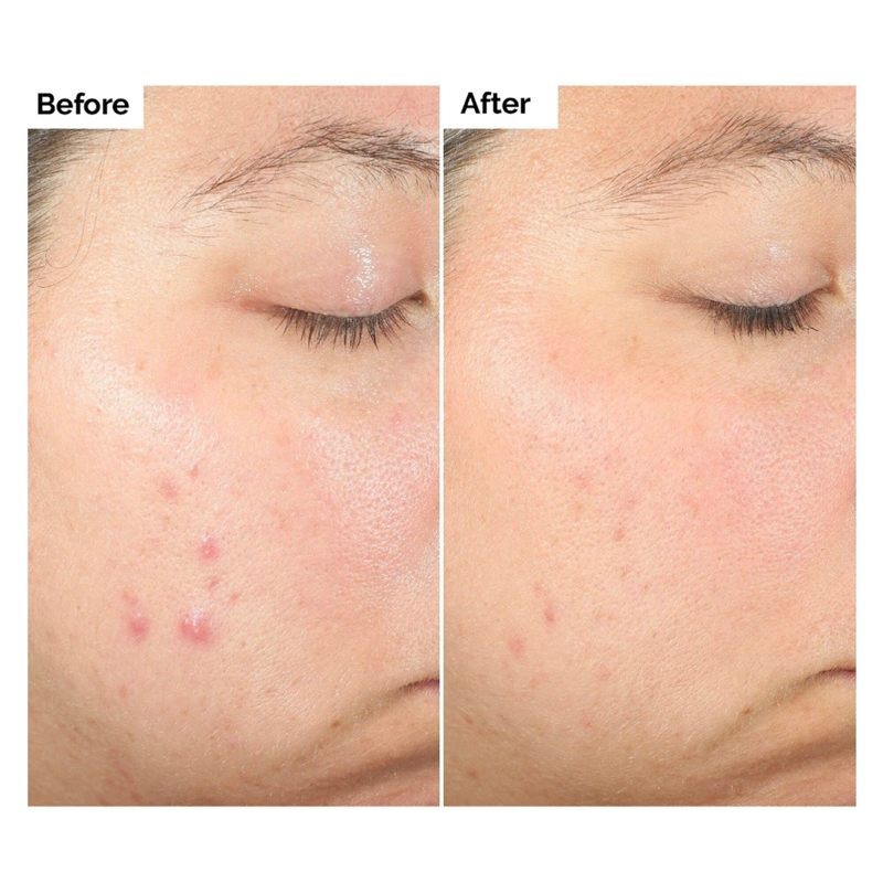 Serum tẩy tế bào chết The Ordinary Salicylic Acid 2% Solution 30ml