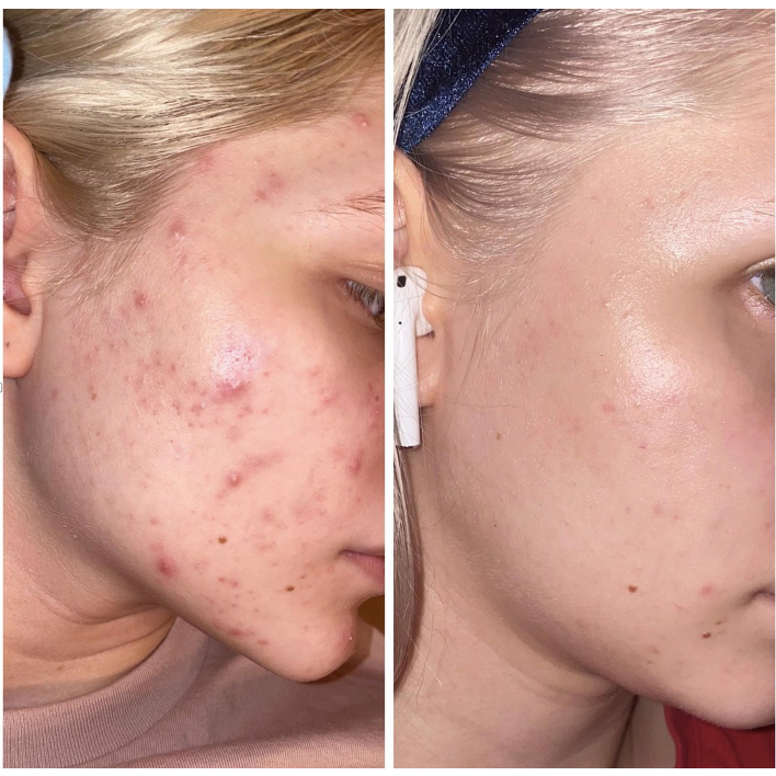 Sáng da chống lão hóa Mandelic Acid 10% + HA - The Ordinary