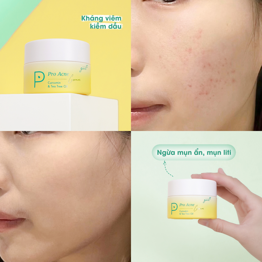 Kem Dưỡng Da Mụn Trà Nghệ GUO - Pro Acne Cream 30gr