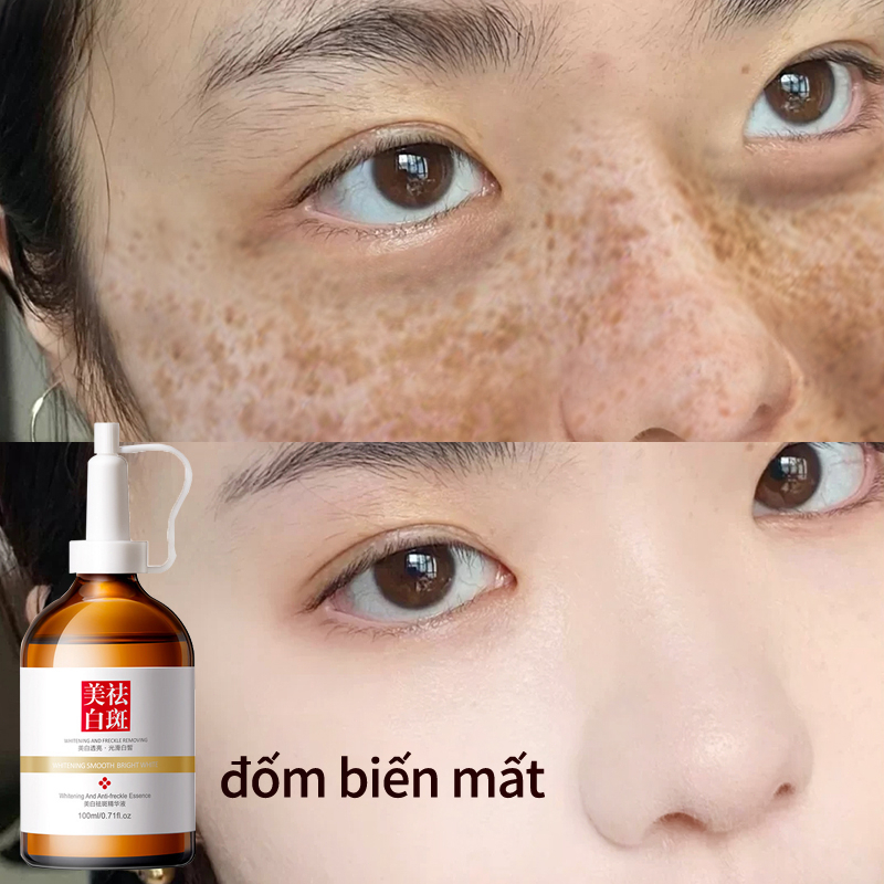 Tinh chất làm trắng sạch tàn nhang 100ml làm sáng da Dưỡng trắng mịn da ,Hiệu quả làm mờ thâm nám tàn nhan,kem thâm nám