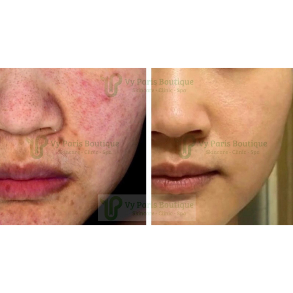 Serum Ampoule B5 Ahohaw 30ml cấp ẩm phục hồi da tổn thương mẩn đỏ
