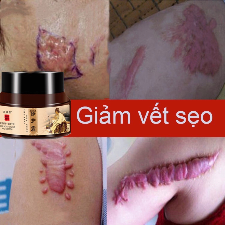 「  24 giờ giao hàng」Kem Sẹo Kem xóa Sẹo Thâm Kem sẹo 50g Xóa sẹo thâm rạn da hiệu quả mờ thâm bỏng thương phẫu thuật