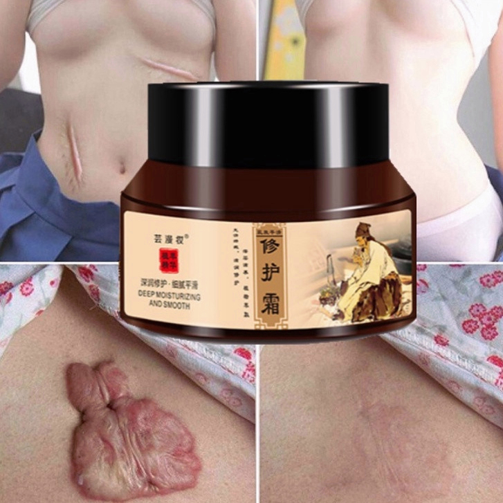 「  24 giờ giao hàng」Kem Sẹo Kem xóa Sẹo Thâm Kem sẹo 50g Xóa sẹo thâm rạn da hiệu quả mờ thâm bỏng thương phẫu thuật