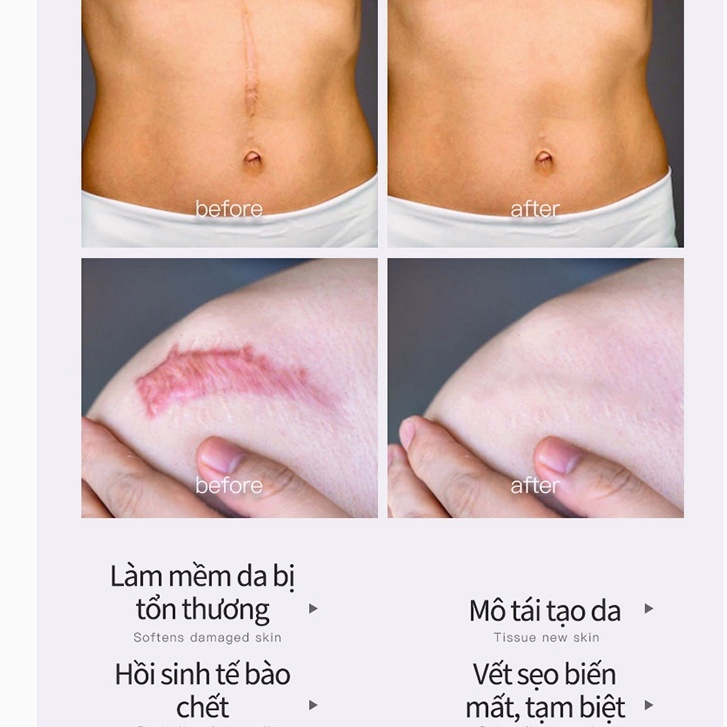 「  24 giờ giao hàng」Kem Sẹo Kem xóa Sẹo Thâm Kem sẹo 50g Xóa sẹo thâm rạn da hiệu quả mờ thâm bỏng thương phẫu thuật