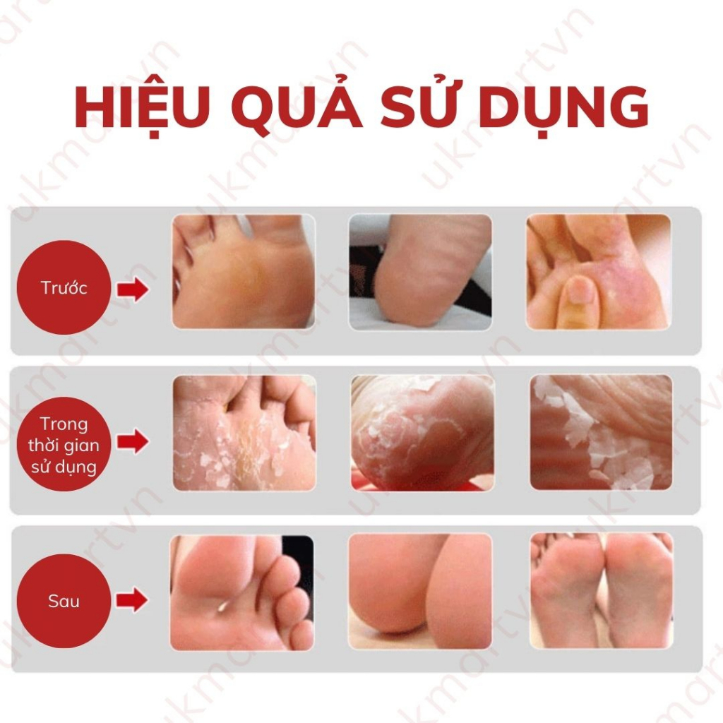 Túi Ủ Tẩy Tế Bào Chết Chân PERORIN Nhật Bản Cho Da Chân Căng Bóng Mịn